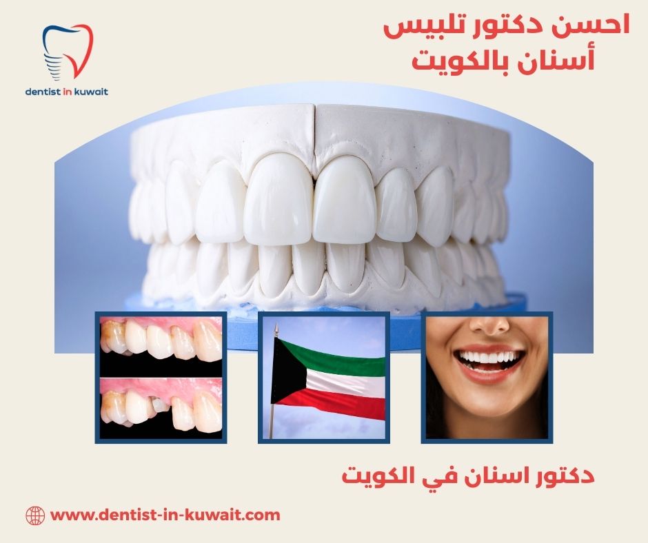احسن دكتور تلبيس أسنان بالكويت