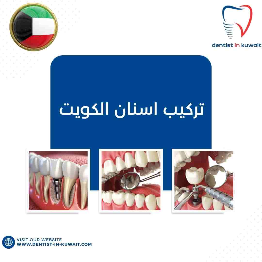تركيب اسنان الكويت