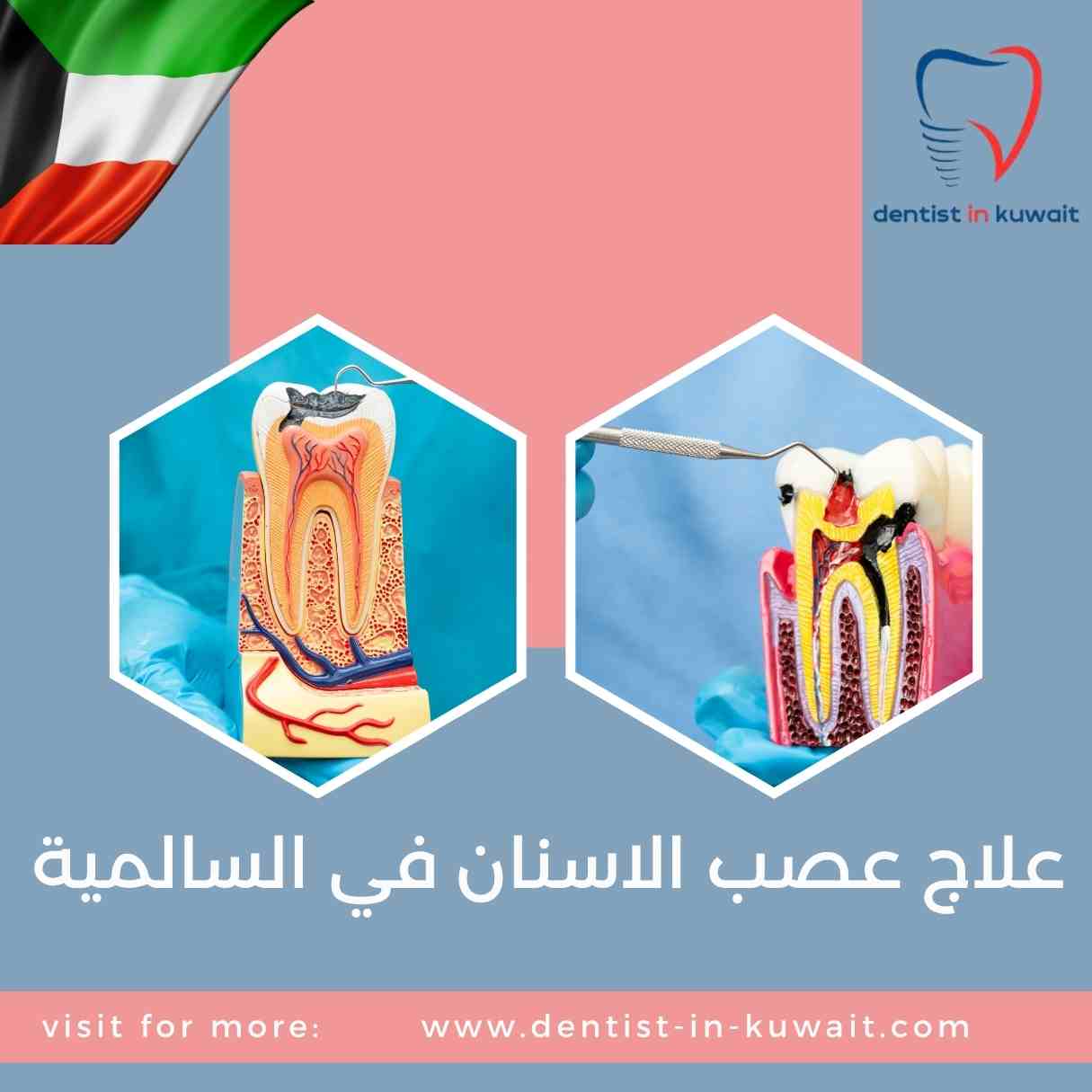 علاج عصب الاسنان في السالمية