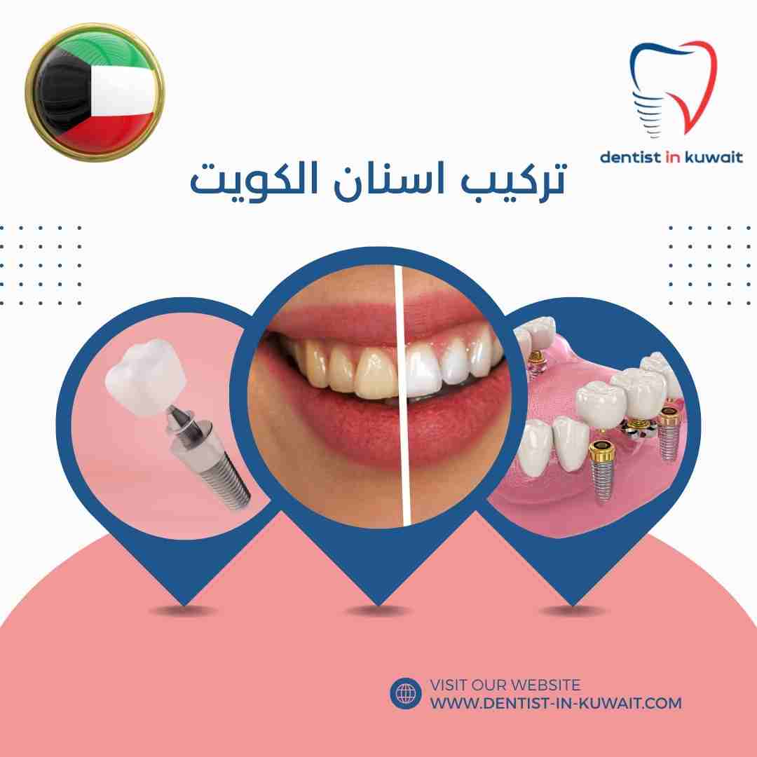 تركيب اسنان الكويت