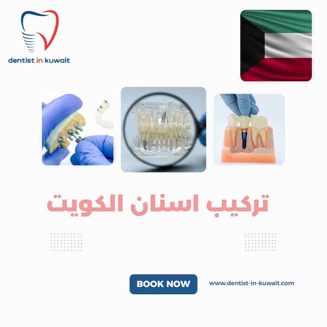 تركيب اسنان الكويت