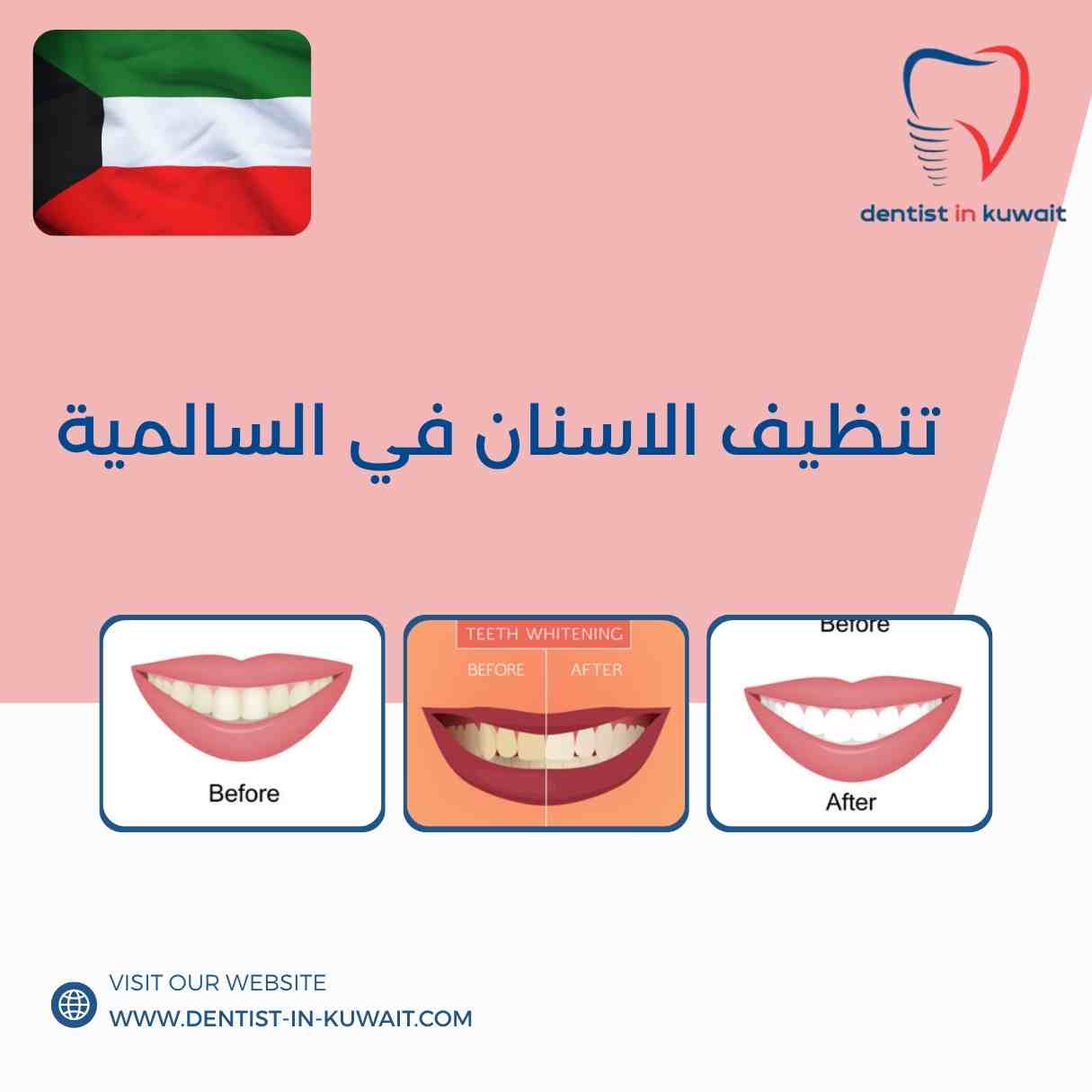 تنظيف الاسنان في السالمية