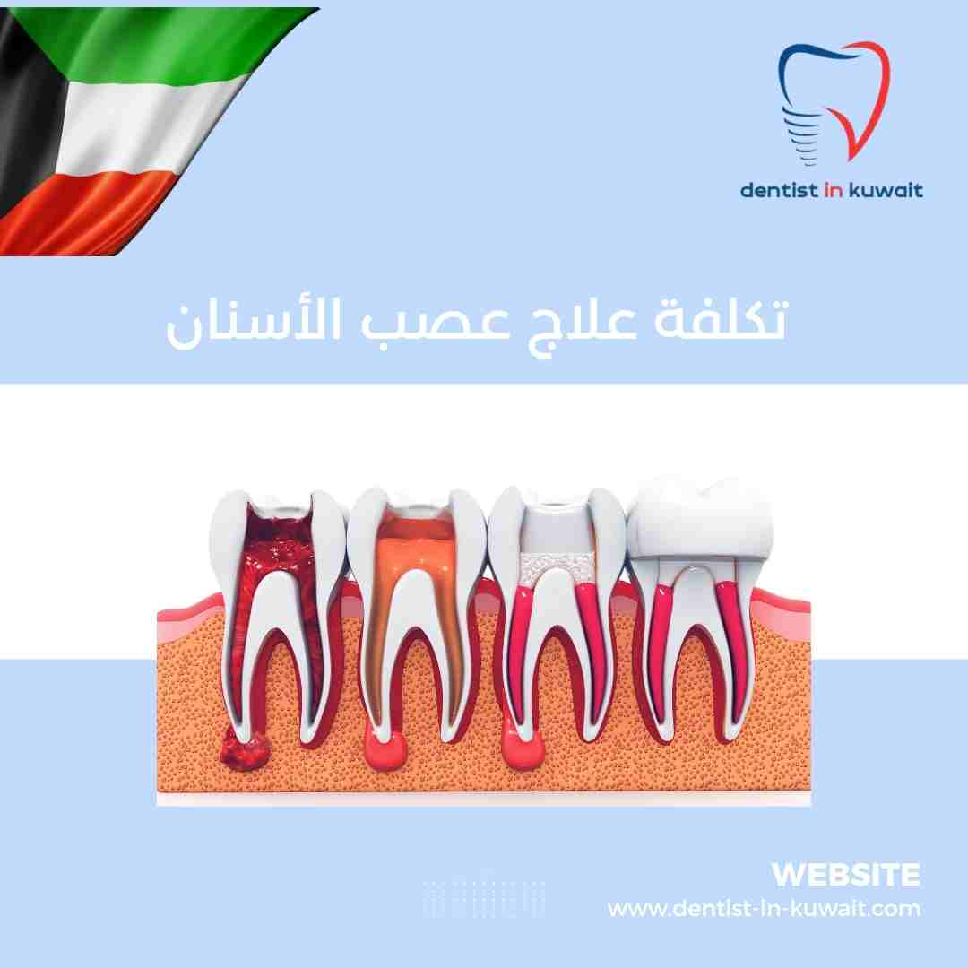 تكلفة علاج عصب الأسنان