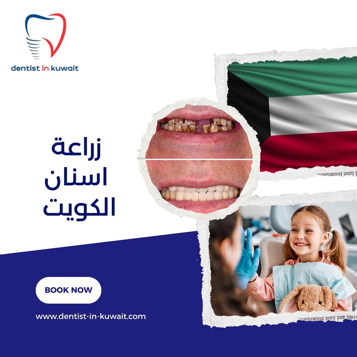 زراعة اسنان الكويت