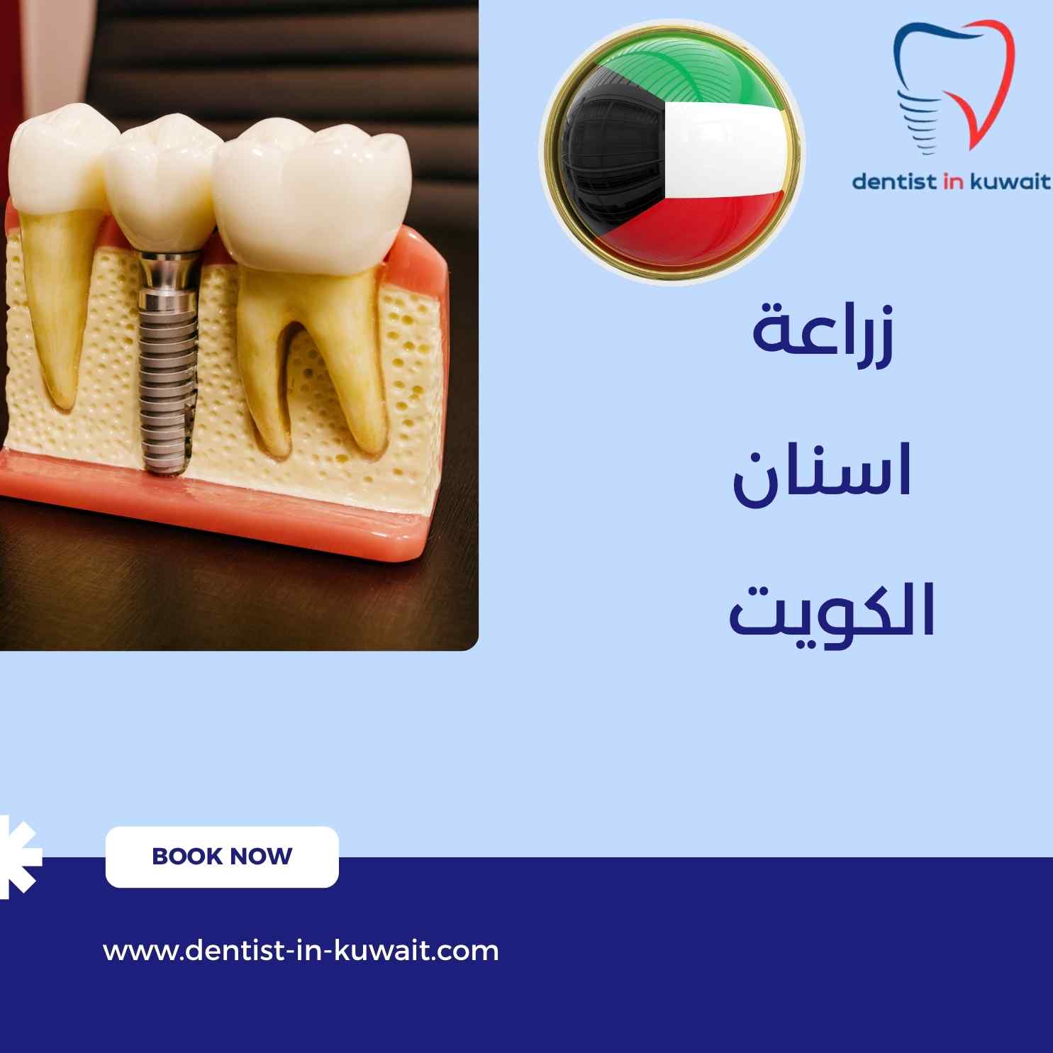 زراعة اسنان الكويت