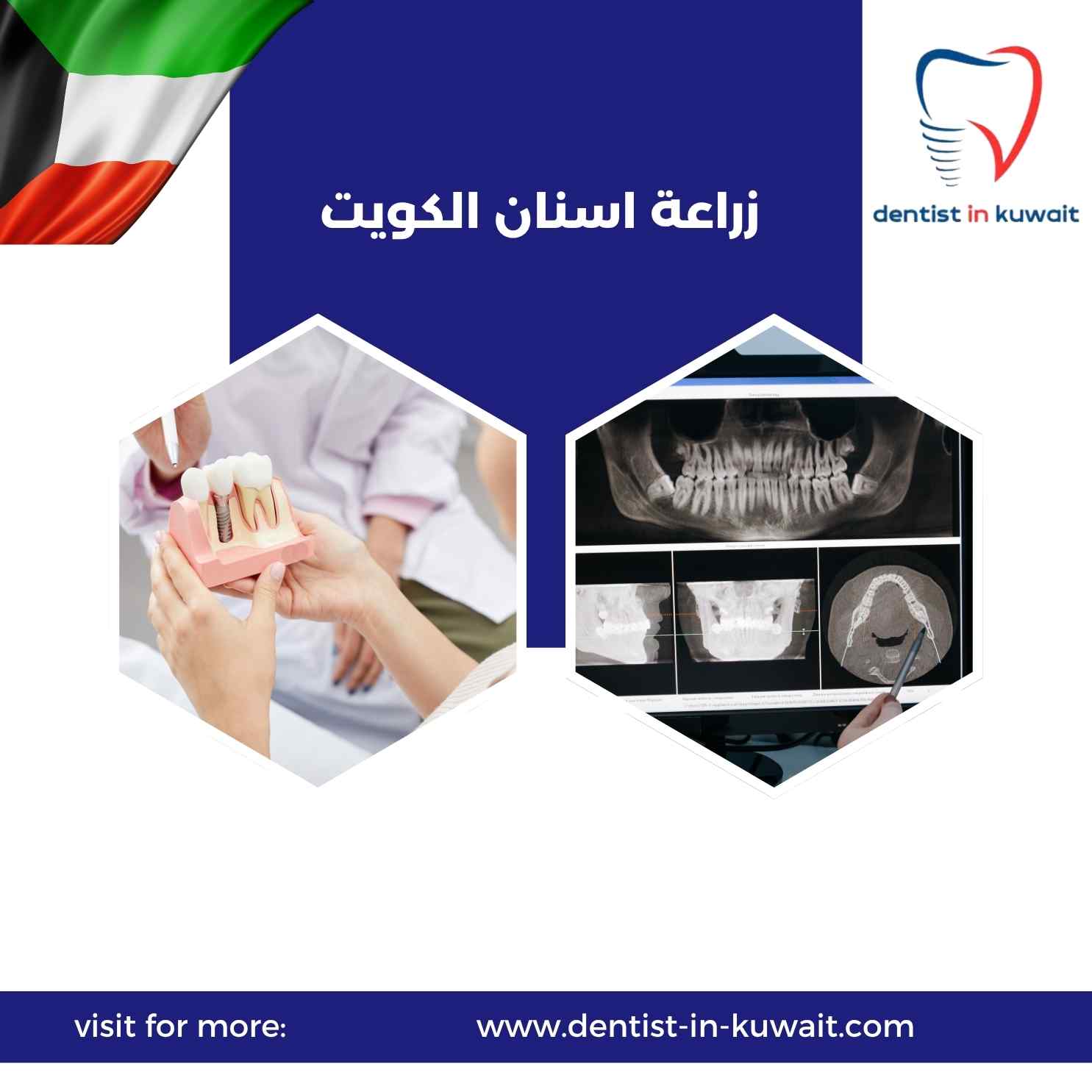 زراعة اسنان الكويت