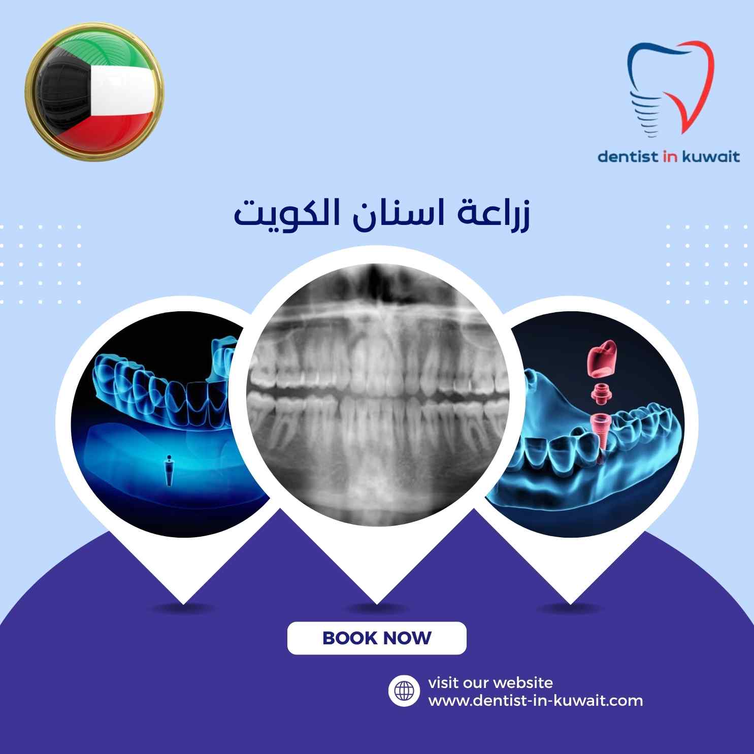 زراعة اسنان الكويت