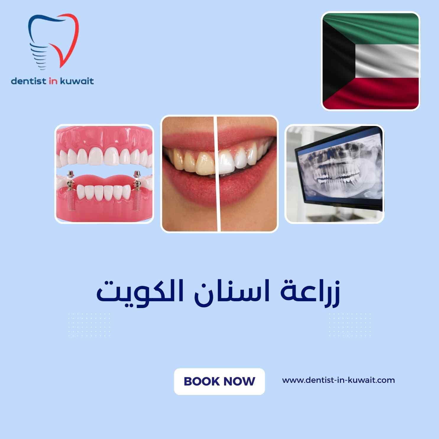 زراعة اسنان الكويت