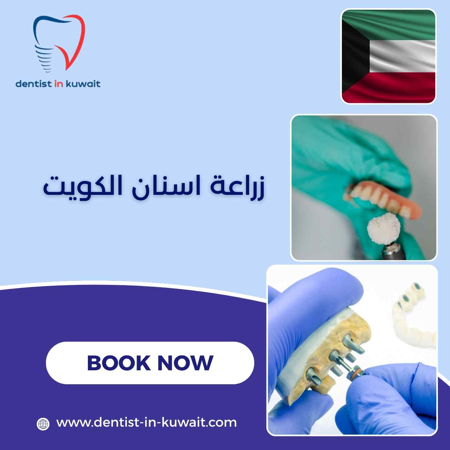 زراعة اسنان الكويت
