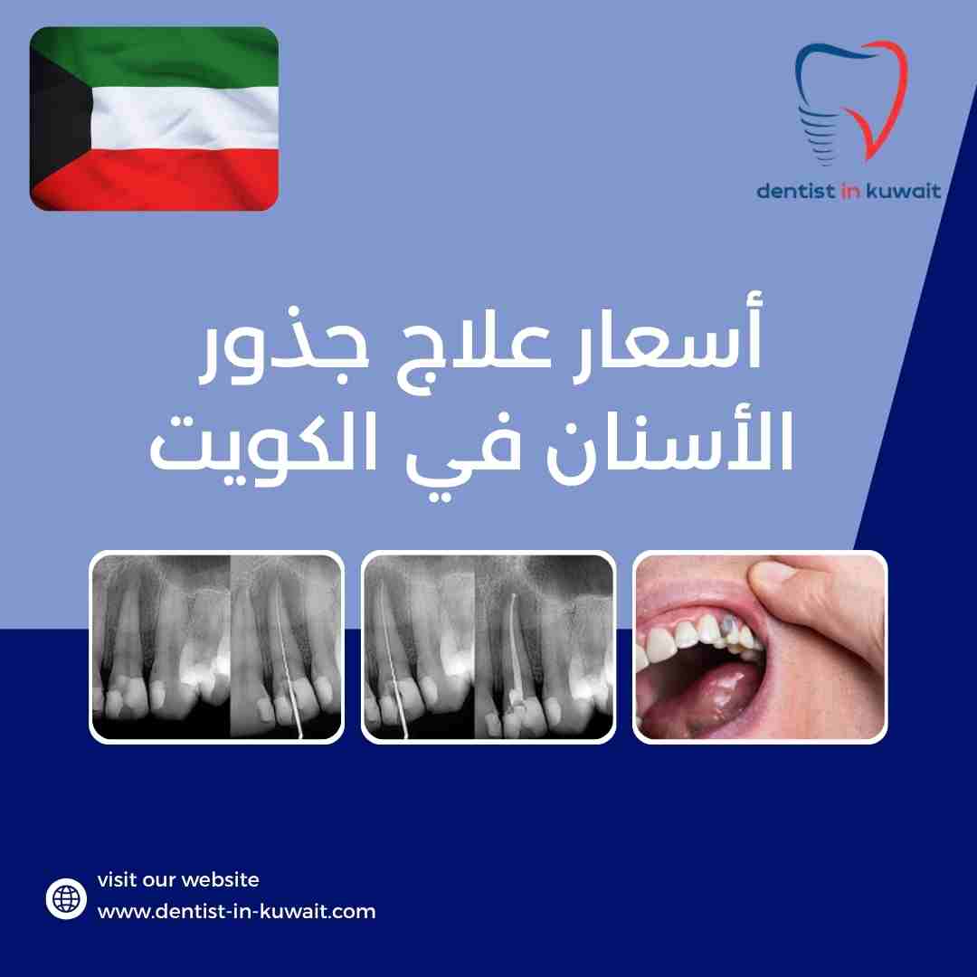 أسعار علاج جذور الأسنان في الكويت