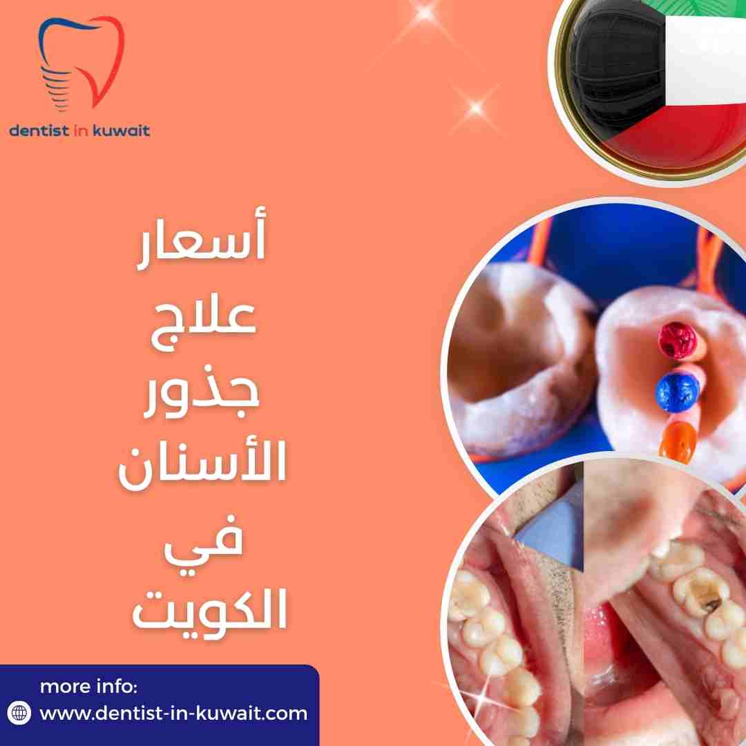 أسعار علاج جذور الأسنان في الكويت