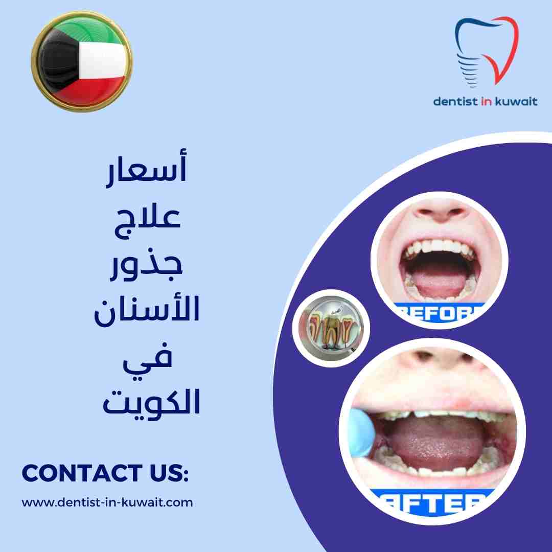 أسعار علاج جذور الأسنان في الكويت