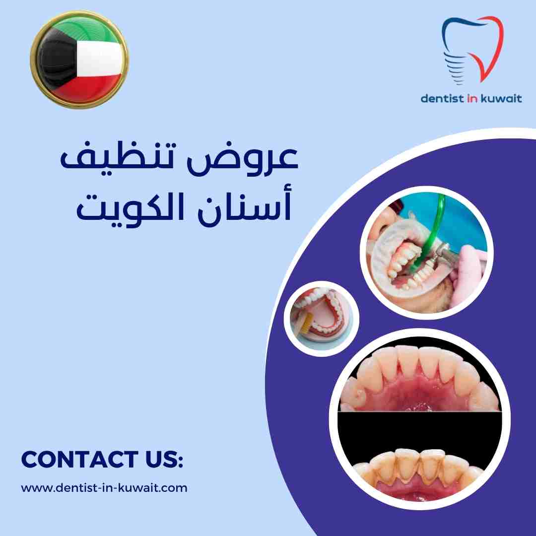 عروض تنظيف أسنان الكويت