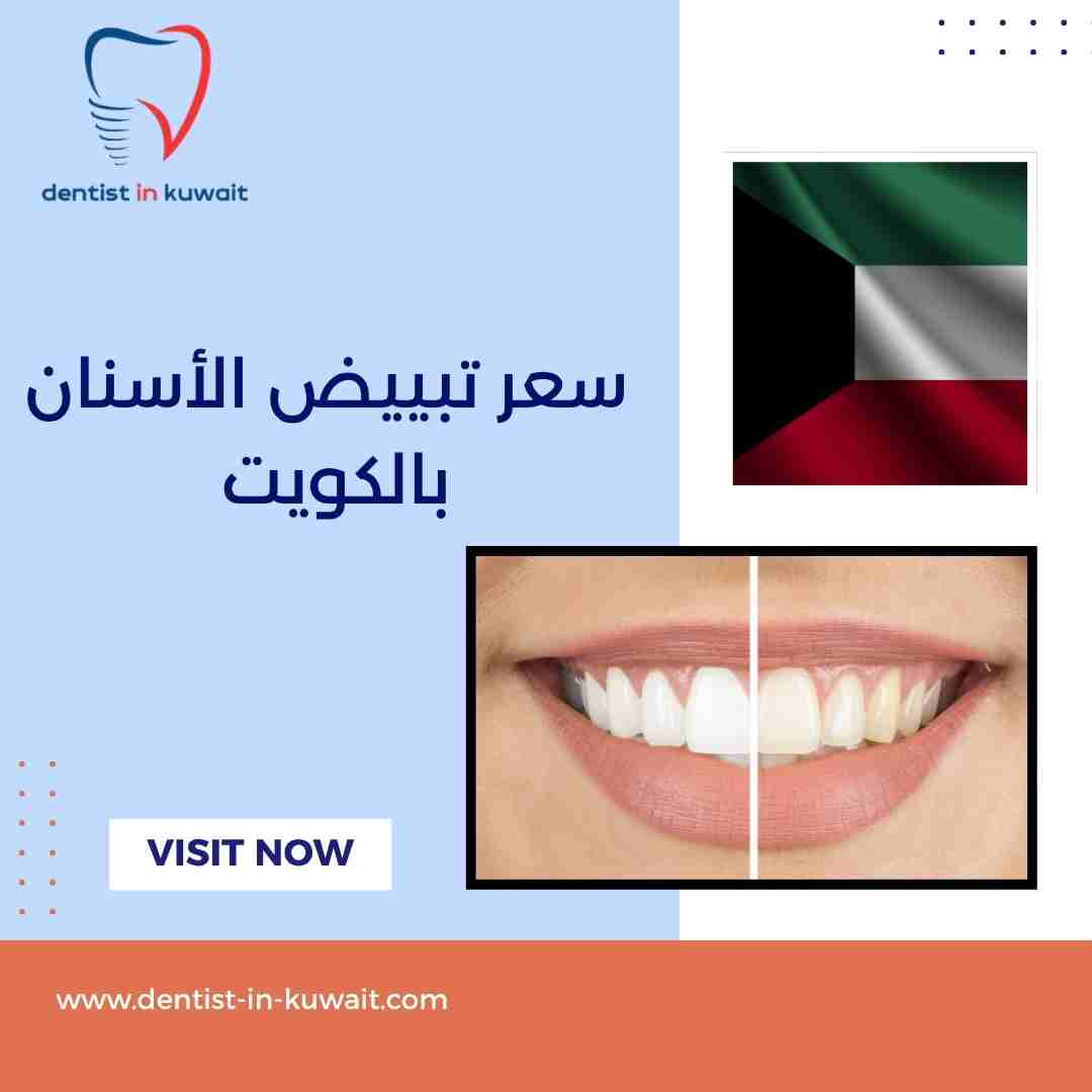 سعر تبييض الأسنان بالكويت