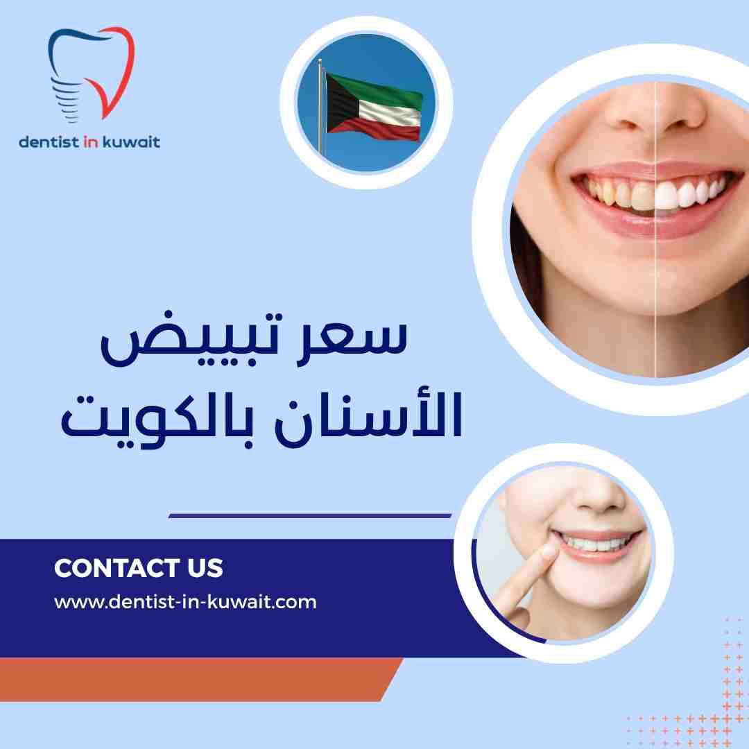 سعر تبييض الأسنان بالكويت