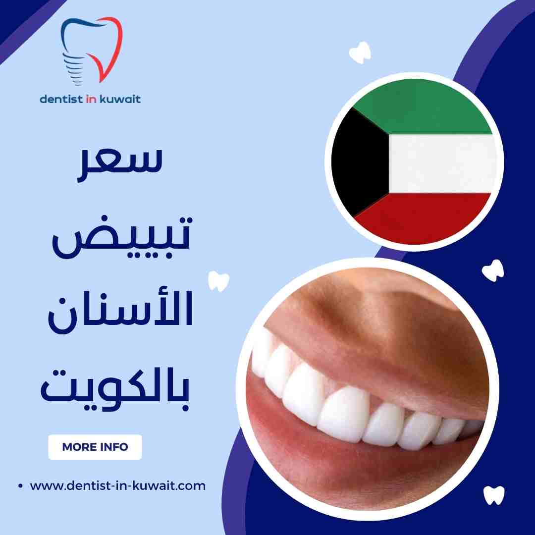 سعر تبييض الأسنان بالكويت