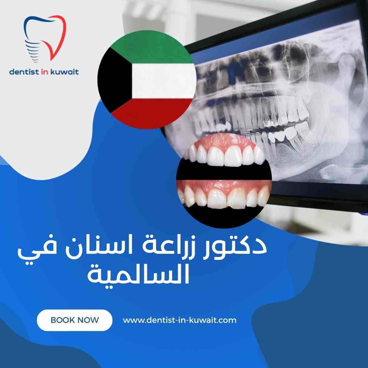 دكتور زراعة اسنان في السالمية