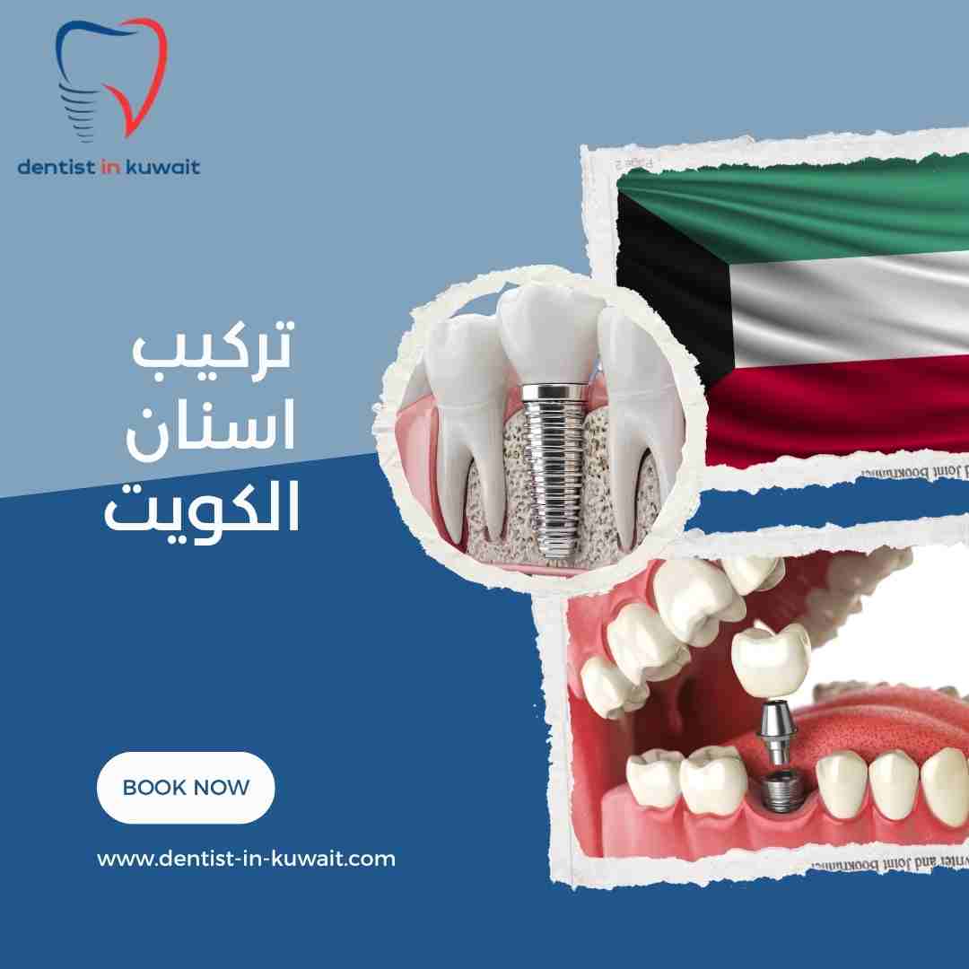 تركيب اسنان الكويت