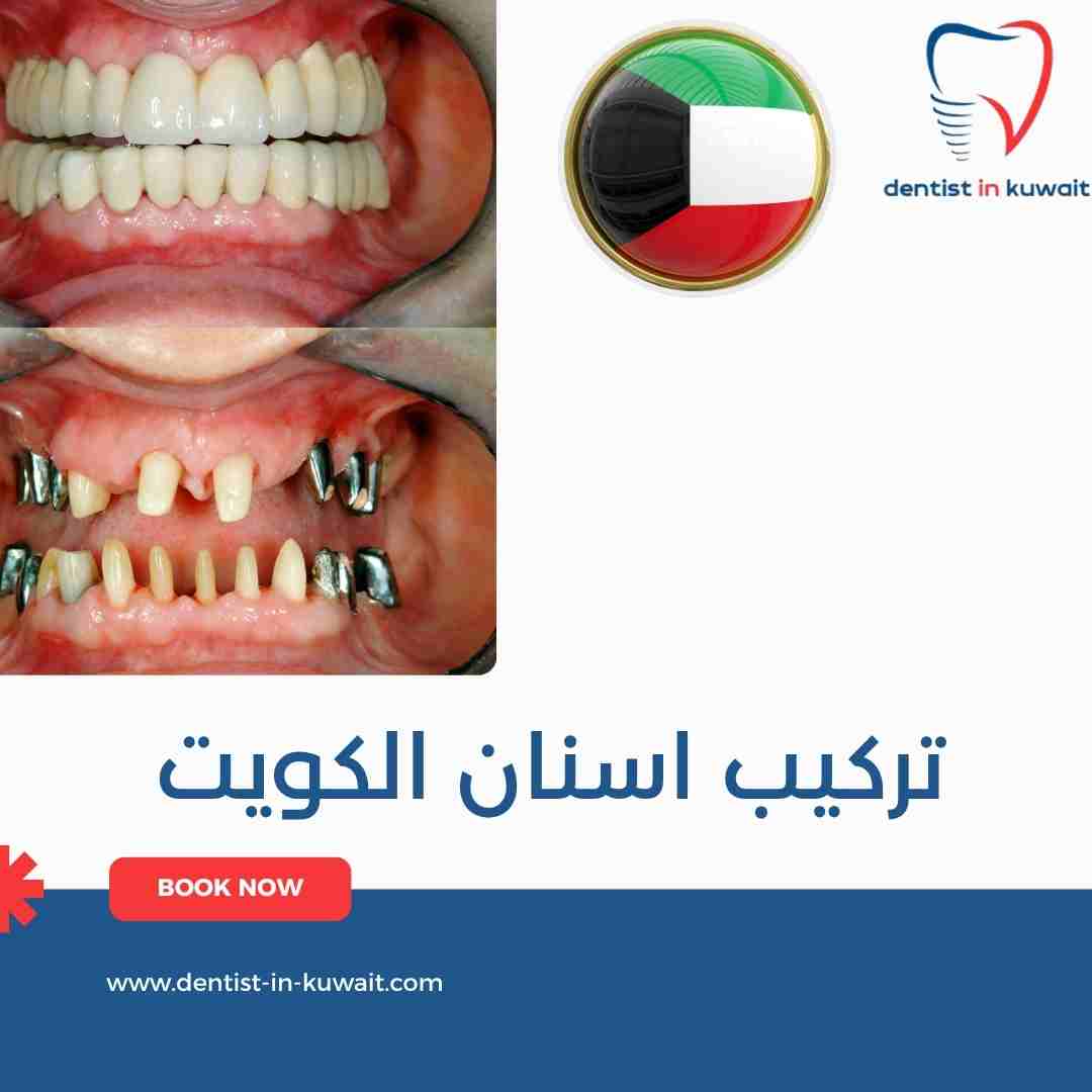 تركيب اسنان الكويت